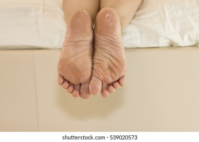 Dry Skin Of The Feet. Foot Treatment. After Using The Mask For Skin Rejuvenation.