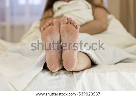 Dry skin of the feet. Foot Treatment. After using the mask for skin rejuvenation. Girl sitting on the bed, feet in focus.