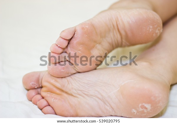 treatment for dry skin on feet