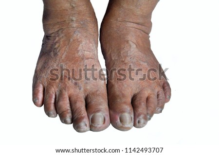The dry skin feets of the old man have many veins and dark skin.
