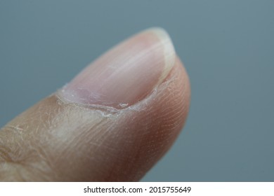 Dry Cuticles High Res Stock Images Shutterstock