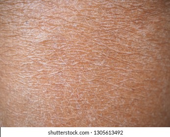 Dry skin or ichthyosis texture detail on leg women using for skincare and moisturizer lotion, cream or cosmetics product concept, Macro shot photo.