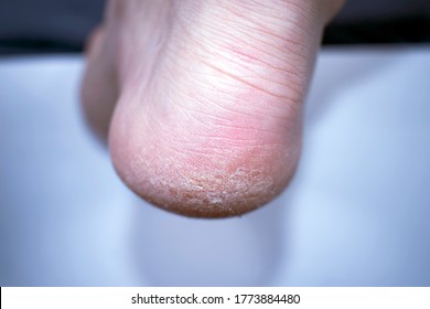 Dry skin on the feet