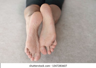 Dry Skin On Female Foot And Toes. Health Problems. Vitamin A And E Deficiency