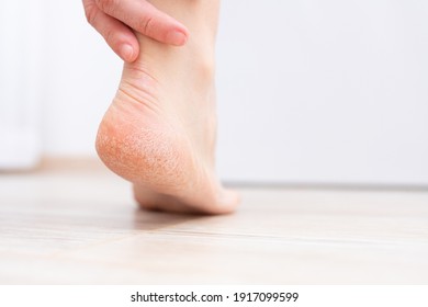 The dry skin on the heel is cracked. Treatment concept with moisturizing creams and exfoliation for healing wounds and pain when walking. Dehydrated skin on the heels of female feet