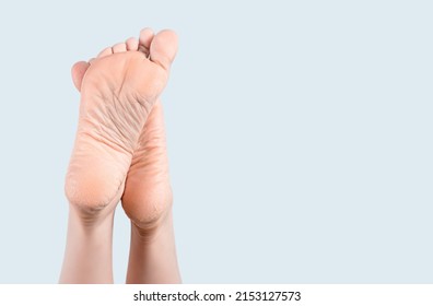 Dry skin on heel. Female feet turned up, sole care, moisturizers and creams. Dry and cracked soles of feet on gray background, foot with dry heels. Female feet turned up