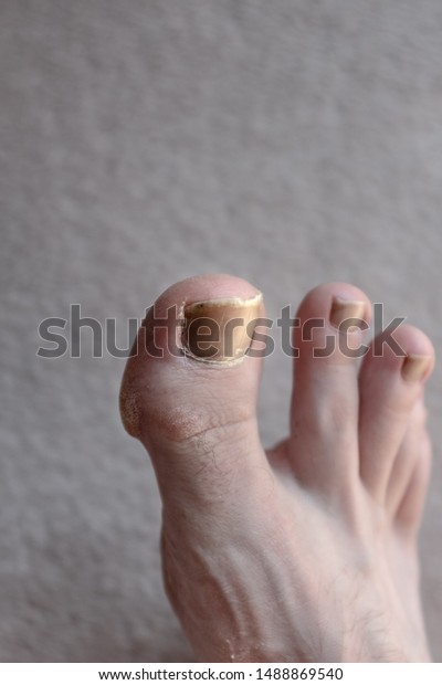 dry toe skin