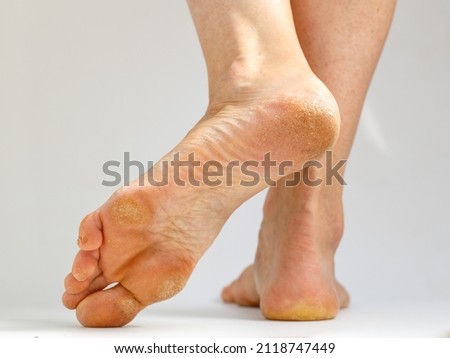 Dry skin, plantar callosity and flakes on the female heel and feet sole close up on white background. Image for medical purposes.