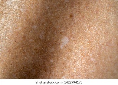 Sun Spots On Skin Images Stock Photos Vectors Shutterstock