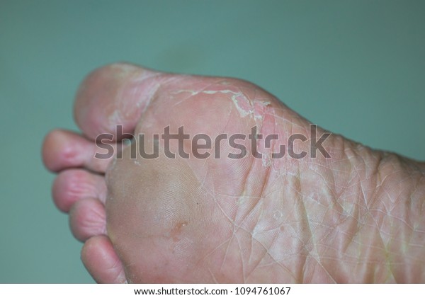 peel dry skin off feet