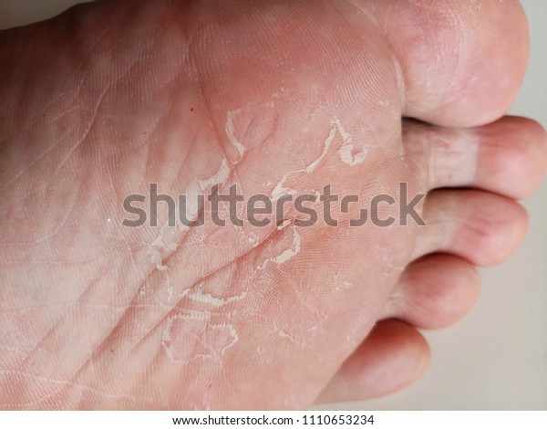 dry skin under foot
