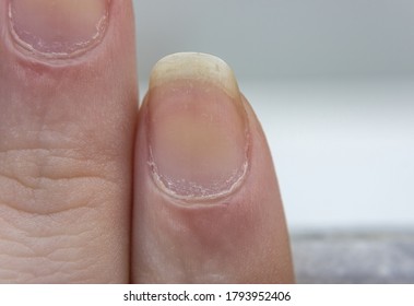 Dry Yellow Nails . Damaged Fingernails . Chipped Nails