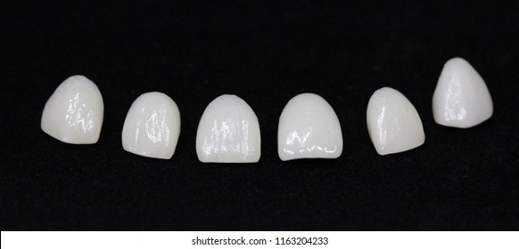 E.Max Veneers With Porcelain