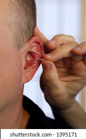 Ear Acupuncture