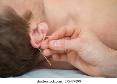 Ear Acupuncture