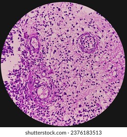 Ear (biopsy): Microphotograph of Granulation tissues, show dense infiltration of polymorphs, lymphocytes, histiocytes and foreign body giant cell. proliferation of fibroblasts, keratinocytes.