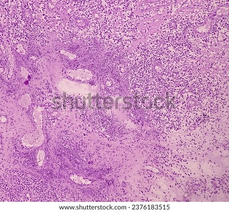 Ear (biopsy): Microphotograph of Granulation tissues, show dense infiltration of polymorphs, lymphocytes, histiocytes and foreign body giant cell. proliferation of fibroblasts, keratinocytes.