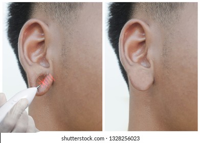 For ear decorations, large scars, And before - after the repair.Picture concept,
Laser scar removal.