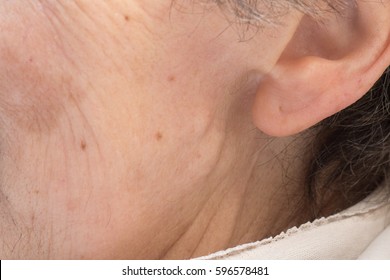 Ear Lobe Detachment In A Aged Woman With Parotid Cancer