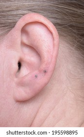 Ear With Longtime Acupuncture