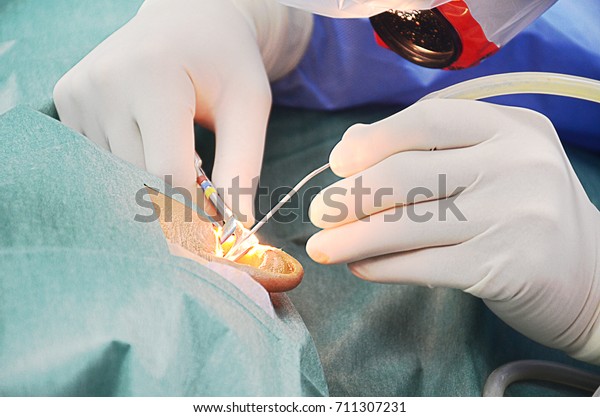 Ear surgery by micro\
surgery.