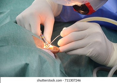 Ear Surgery By Microsurgery.