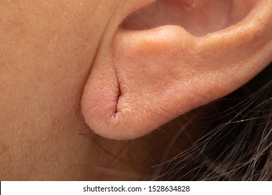 Earlobe With Former Piercing Hole Mark Close Up