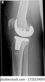 Early follow up lateral view x-ray after total knee replacement with correct implant orientation