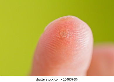 verruca images stock photos vectors shutterstock early wart