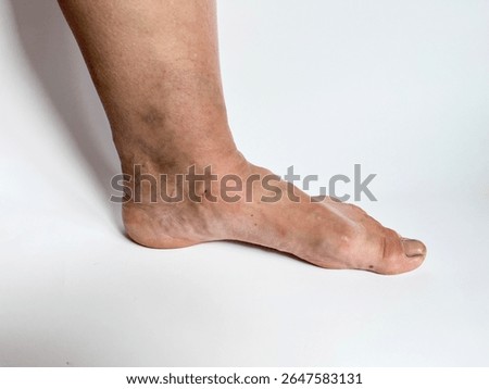 Early varicose symptoms include mild vein bulging, heaviness and skin discoloration on foot area, suggesting onset of venous circulation issues and vascular weakness. varicose veins on legs 