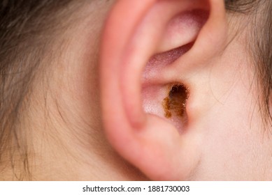 Earwax In The Dirty Ear Of A Child. Hole Ear Of Human, Wax On Hair And Skin Of Ear.