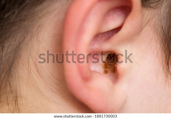 Earwax in the dirty ear of a child. Hole ear\
of human, wax on hair and skin of\
ear.