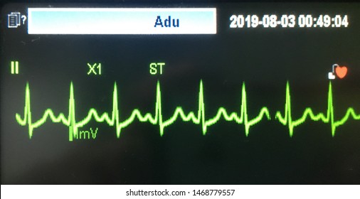 Ecg Bradycardia T Wave Abnormality Stock Photo 1468779557 | Shutterstock