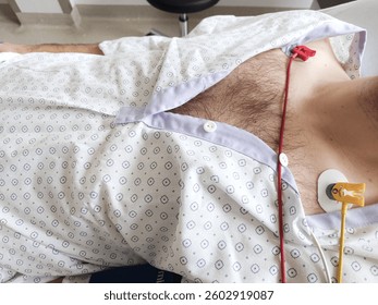 ECG or EKG or electrocardiogram electrodes connected to a Caucasian man's chest. Lying in hospital bed, medical patient gown, close up shot, unrecognizable, clean white bedding.