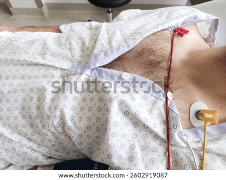ECG or EKG or electrocardiogram electrodes connected to a Caucasian man's chest. Lying in hospital bed, medical patient gown, close up shot, unrecognizable, clean white bedding.