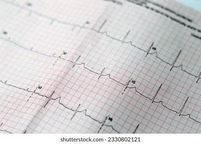 ECG ElectroCardioGraph paper that shows sinus rhythm abnormality of right ventricular hypertrophy, inferior T wave due to hypertrophy and ischemia, Abnormal ECG study, unconfirmed diagnosis - Shutterstock ID 2330802121