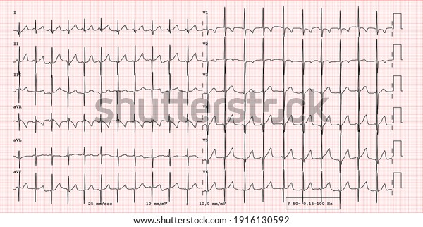 Ecg Example Normal 12lead Sinus Rhythm Stock Photo 1916130592 ...