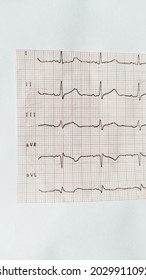 ECG Paper Of The Patient In Hospital On White Background.Showing Normal Sinus Rhythm Of Heart Rate. Electrocardiogram , Medical Care For Heart Failure Patients.