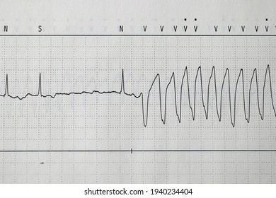 ECG Registration Of A Ventricular Tachycardia 
