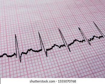 ECG Results Supra Ventricular Tachycardia.