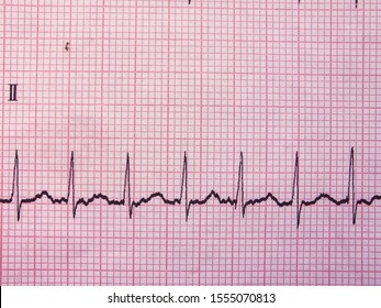 Sinus Arrhythmia High Res Stock Images Shutterstock