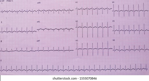 ECG Results Supra Ventricular Tachycardia.