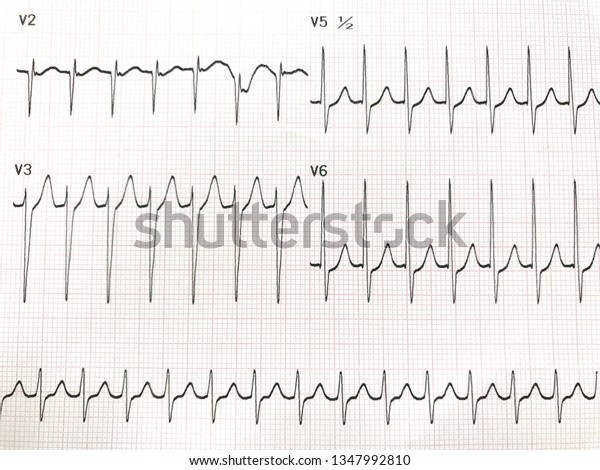 Ecg Results Supra Ventricular Tachycardia Stock Photo (Edit Now) 1347992810