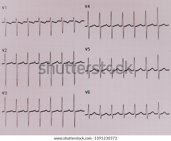 Ecg Results Supra Ventricular Tachycardia Stock Photo (Edit Now) 1391230373