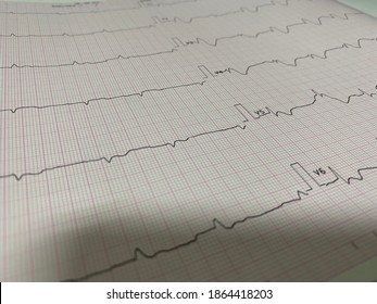 Ecg Showing Widen Qrs Complex