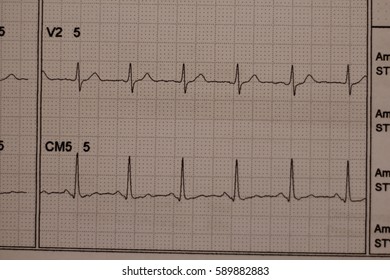 ECG Strip Chart