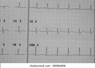 ECG Strip Chart