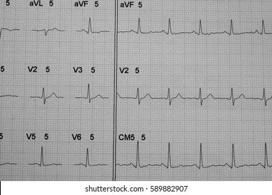 ECG Strip Chart