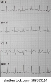 ECG Strip Chart