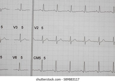 ECG Strip Chart